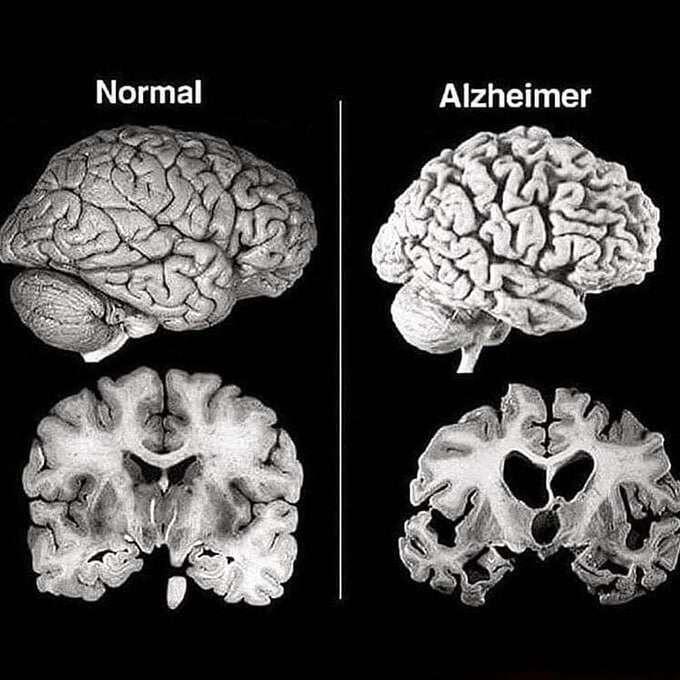 Ahealthy #brain (left) compared to that…