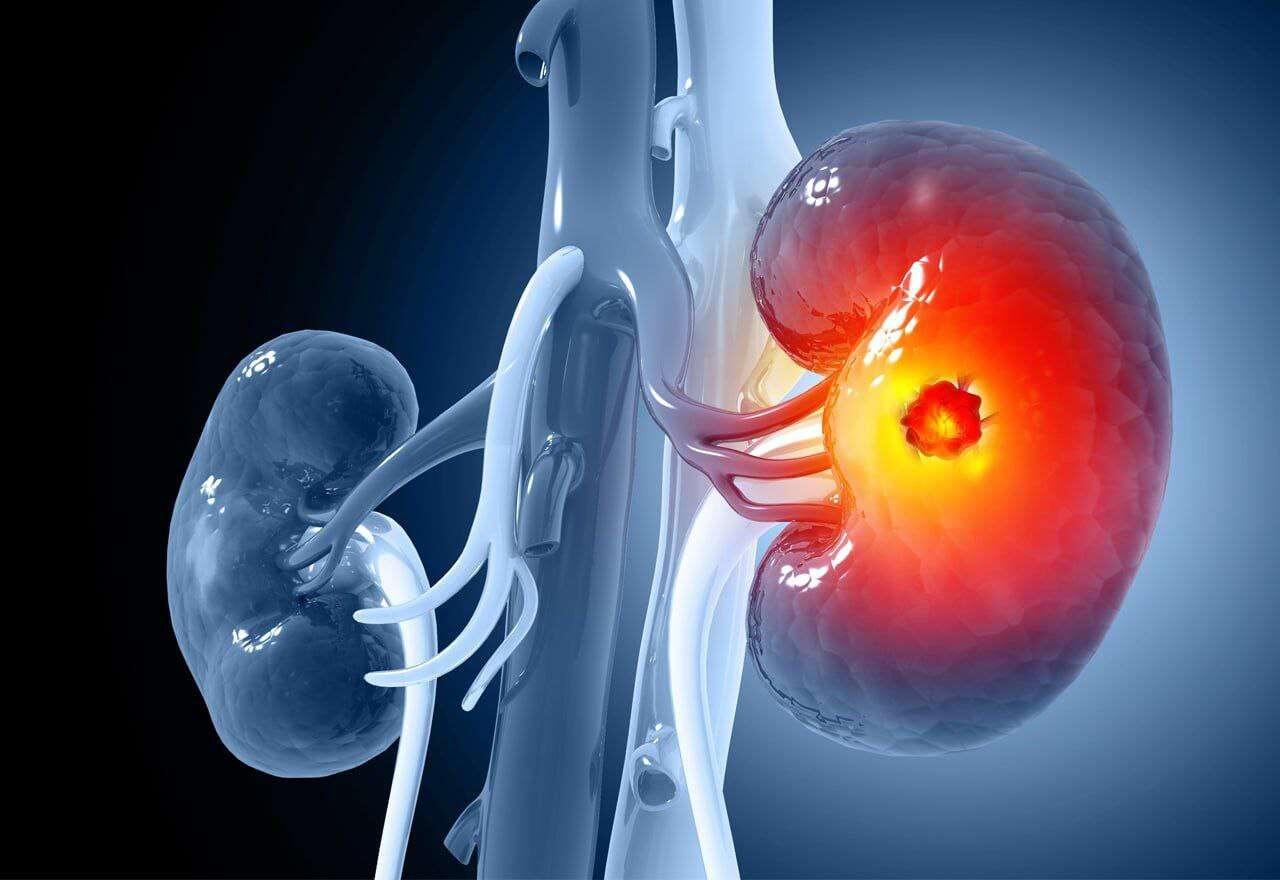 A vaccine against kidney cancer has…