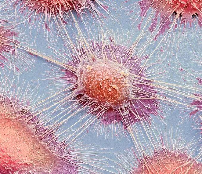 #Cancer #Cell under a #Microscope