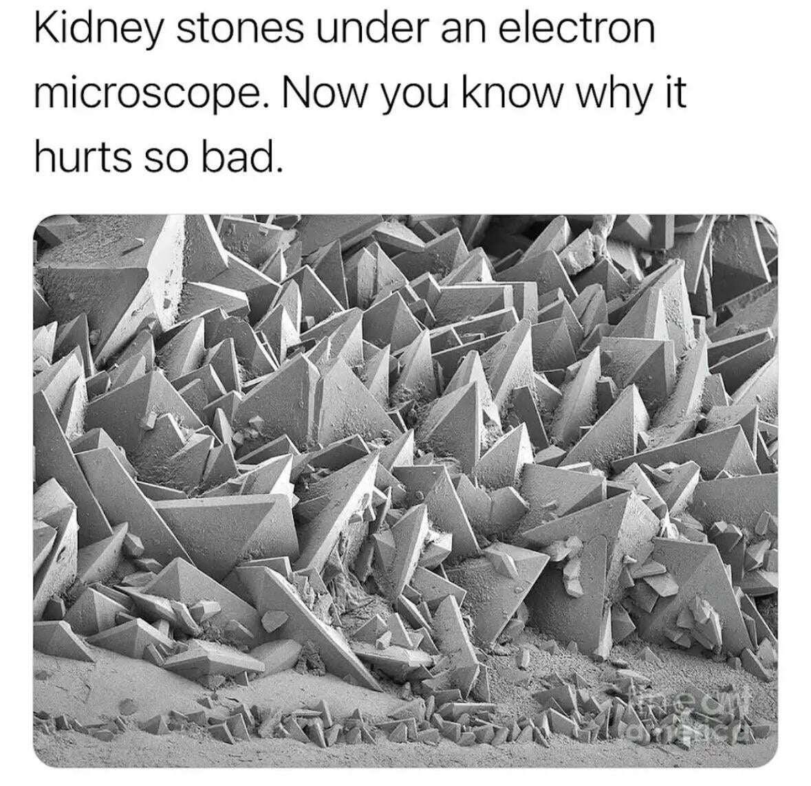 #kidney #stones